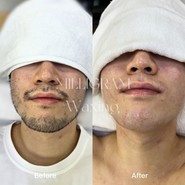 [경북 구미] 밀리그램스칼프X모먼트스킨