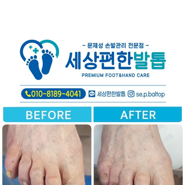 [전남 광양] 세상편한발톱